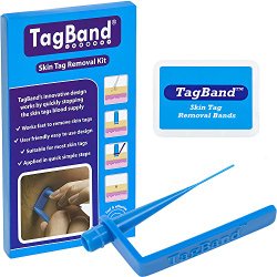 TagBand Skin Tag Removal Device