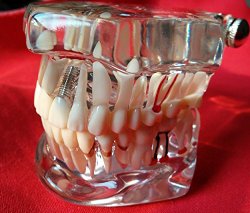 Yosoo Dental Study Teaching Teeth Model Adult Typodont Model Removable Tooth